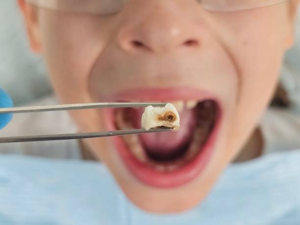 Best Emergency Broken Tooth Repair in Mason Neck, VA