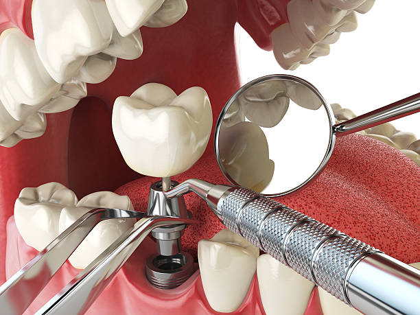 Best Emergency Tooth Extraction in Mason Neck, VA
